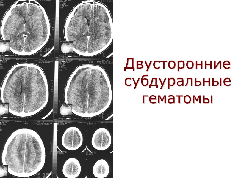 Двусторонние субдуральные гематомы